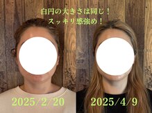 アポヨ鍼灸院(APOYO鍼灸院)/美容鍼＋整体　お顔before/after