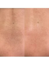 シーアイエステティック 船橋駅前店(c.iエステティック)/背中のハーブピーリング♪