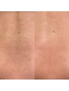 シーアイエステティック 船橋駅前店(c.iエステティック)/背中のハーブピーリング♪