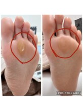 遊歩堂/ヒールダコ