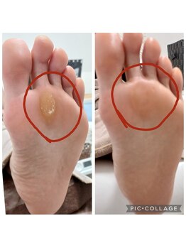 遊歩堂/ヒールダコ