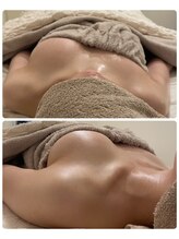 モナンジュ(ramonange)/左側のみ施術後　バストアップ