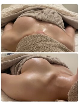 モナンジュ(ramonange)/左側のみ施術後　バストアップ