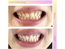 エクシア ホワイトニング 伊勢崎店/