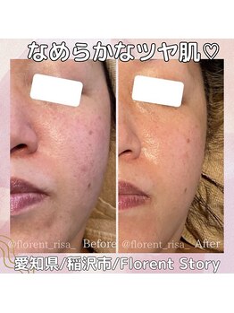 アーキ(ARCHI)/毛穴洗浄＋ヒト幹細胞導入エステ