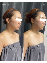 レクシア(LEXIA)/小顔ケア症例｜PRO LIFT 1回目