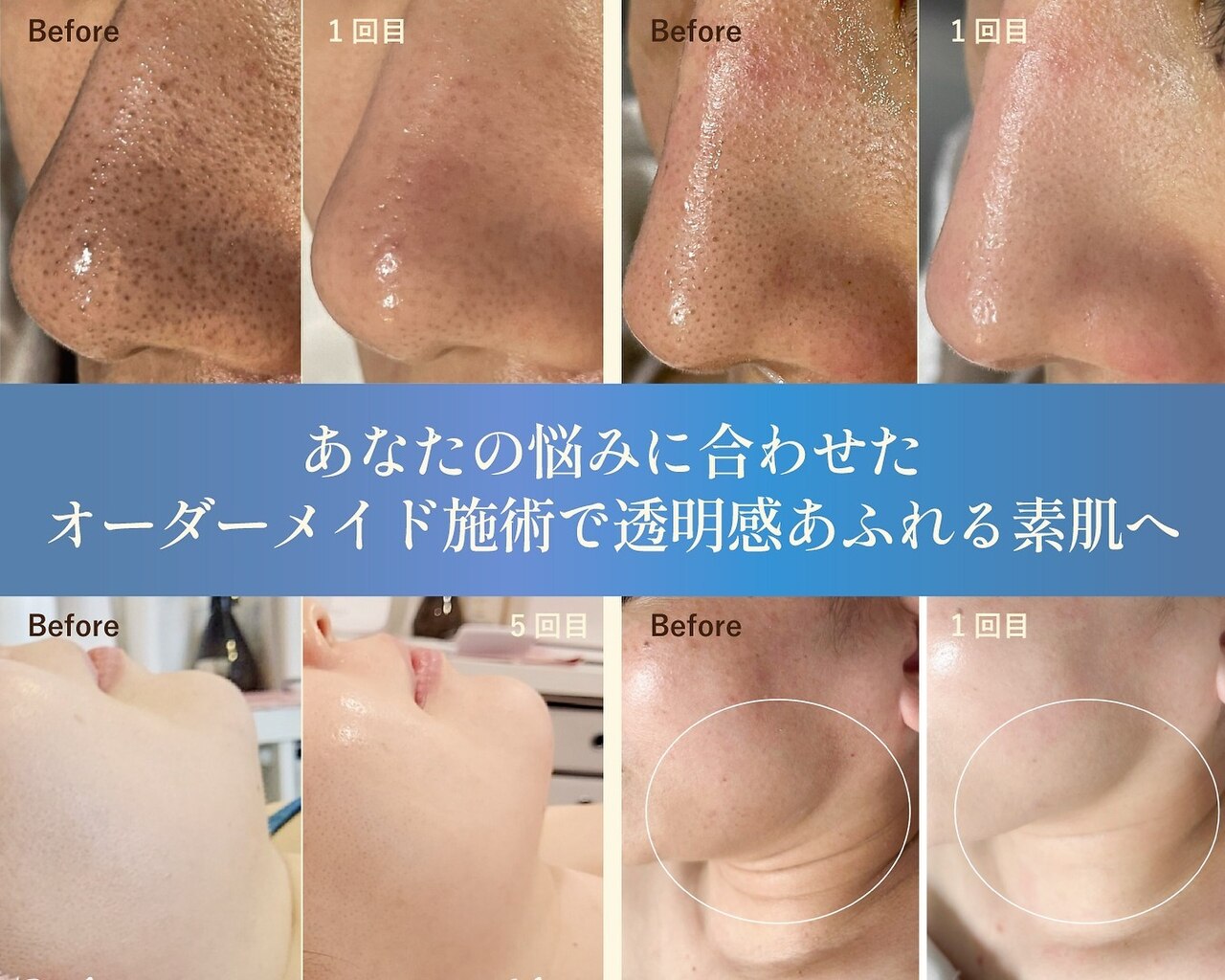 大阪府で毛穴洗浄・毛穴吸引が人気のエステサロン｜ホットペッパー