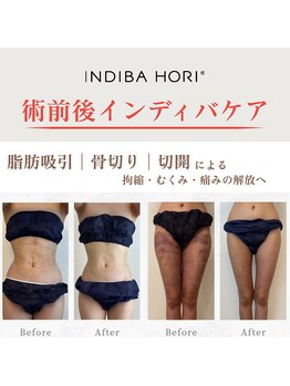 インディバホリトウキョウ(INDIBA HORI TOKYO)の写真/SNSで話題☆INDIBA HORIのダウンタイムケアは結果で証明します！直後からの変化をお楽しみに。