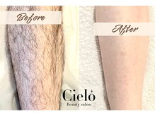 シエロ 川崎店(Cielo)/気になるひざ下脱毛