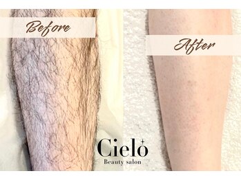 シエロ 川崎店(Cielo)/気になるひざ下脱毛