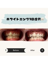 リファイン(Refine)/セルフホワイトニング