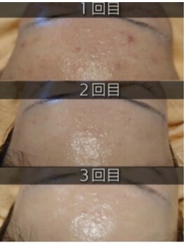 エン(O'en)/エクソソーム＋幹細胞導入♪