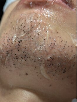 コチカ 恵比寿(KOCKA)の写真/【メンズ専門店】毎朝のヒゲ剃りにうんざりしている人が最短3回(16,000円)で楽になるヒゲ脱毛