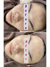 エステサロン桜/バクテリウムピール（肌育）