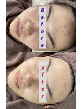 エステサロン桜/バクテリウムピール（肌育）