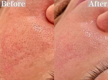 銀座ナチュラル スタイル (Natural Style)/毛穴の開きに/イオン導入