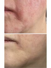 マリエンドリー/肌荒れ