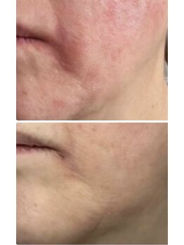 マリエンドリー/肌荒れ