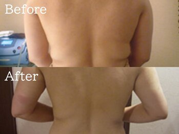 セレブリボーン 大阪ボーテ/サーモシェイプDEEP