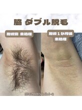 ビビユー(bibi u)/脇ダブル脱毛ビフォーアフター