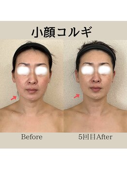 リーブル(LIBRE)/小顔コルギ 5回