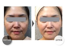 マリス(MARISS)/復元パックB&A <シミたるみ改善>