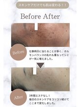 マインドール/頑固なシミも集中ケア人気！