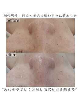 ヴェルシック(Belchic)/毛穴汚れとザラつきまとめて改善