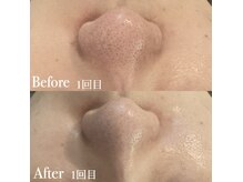 ボディヒーリングアンド小顔美容矯正 プララン/毛穴ビフォーアフター