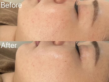 スウィート リリー(Sweet Lily)/エステ版ダーマ