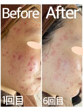 おうちサロン ミキ/BeforeAfterピーリング