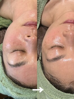 ルーチェ(LUCE)/贅沢肌別パック小顔フェイシャル