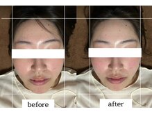 ダイアリー(DIARY)/小顔矯正