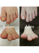 オーガニックネイルサロン プティ ボア(petit bois)/【巻き爪矯正】3回目