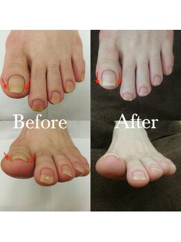 【巻き爪矯正】3回目