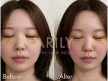 アリリィ(ARILY)/ダウンタイムケア/表参道/外苑前