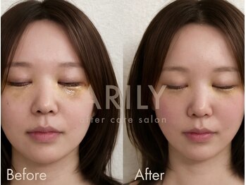 アリリィ(ARILY)/ダウンタイムケア/表参道/外苑前