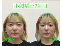 オズ六本木/小顔矯正モニター様＠オズ六本木