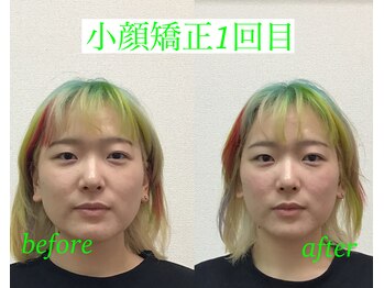オズ六本木/小顔矯正モニター様@オズ六本木