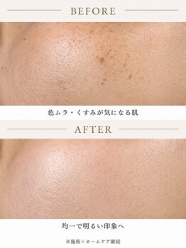 ハス(hasu.)/月1回施術＋ホームケア継続