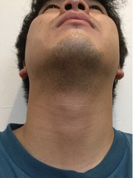 ディークロス(D cross)/メンズヒゲ脱毛