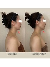 リーブル(LIBRE)/小顔コルギ　５回