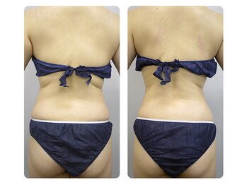 リラクゼーションアンドビューティーボヌール(BONHENR)/筋膜リリース