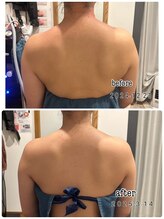 レイール(Reir)/メディセル肩こり改善コース