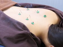 西小山弁天通り 鍼灸治療院の雰囲気(細い鍼を使用しているため痛み少なく、お灸は心地よい熱さ♪)