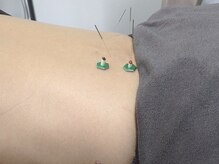 鍼灸マッサージ院りあん 片倉町/鍼灸は温活にも◎