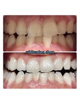 ホワイトニングショップ 池田店/【BEFORE/AFTER】