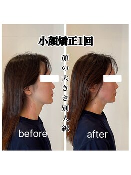 リバイブ 五反田店(REVIVE)/小顔矯正1回《中顔面短縮》