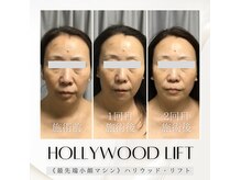 ブリリオプラス 四条烏丸店(Brillio plus)の雰囲気（ハリウッドリフトで直後から小顔を実感！リフトUP/浮腫み/たるみ）