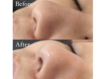 アイラッシュサロンアールツー(eyelash salon R2)/毛穴ハイドロピーリング